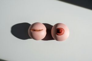collagen and breast cancer myths